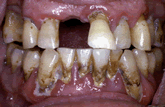 Severe Advanced Periodontitis 